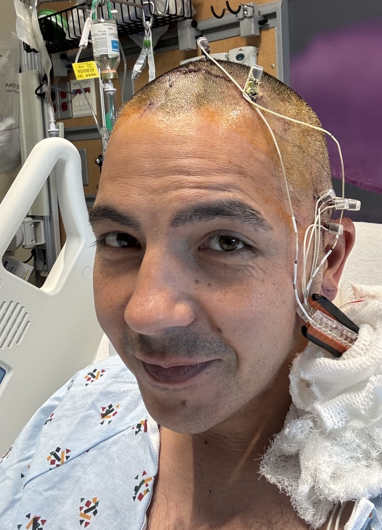 sEEG - removeal stage