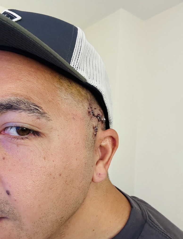 sEEG - wearing my hat to work